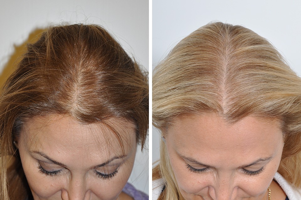 Sapphire Hair Clinic – Modern Hair Transplant Istanbul Methods