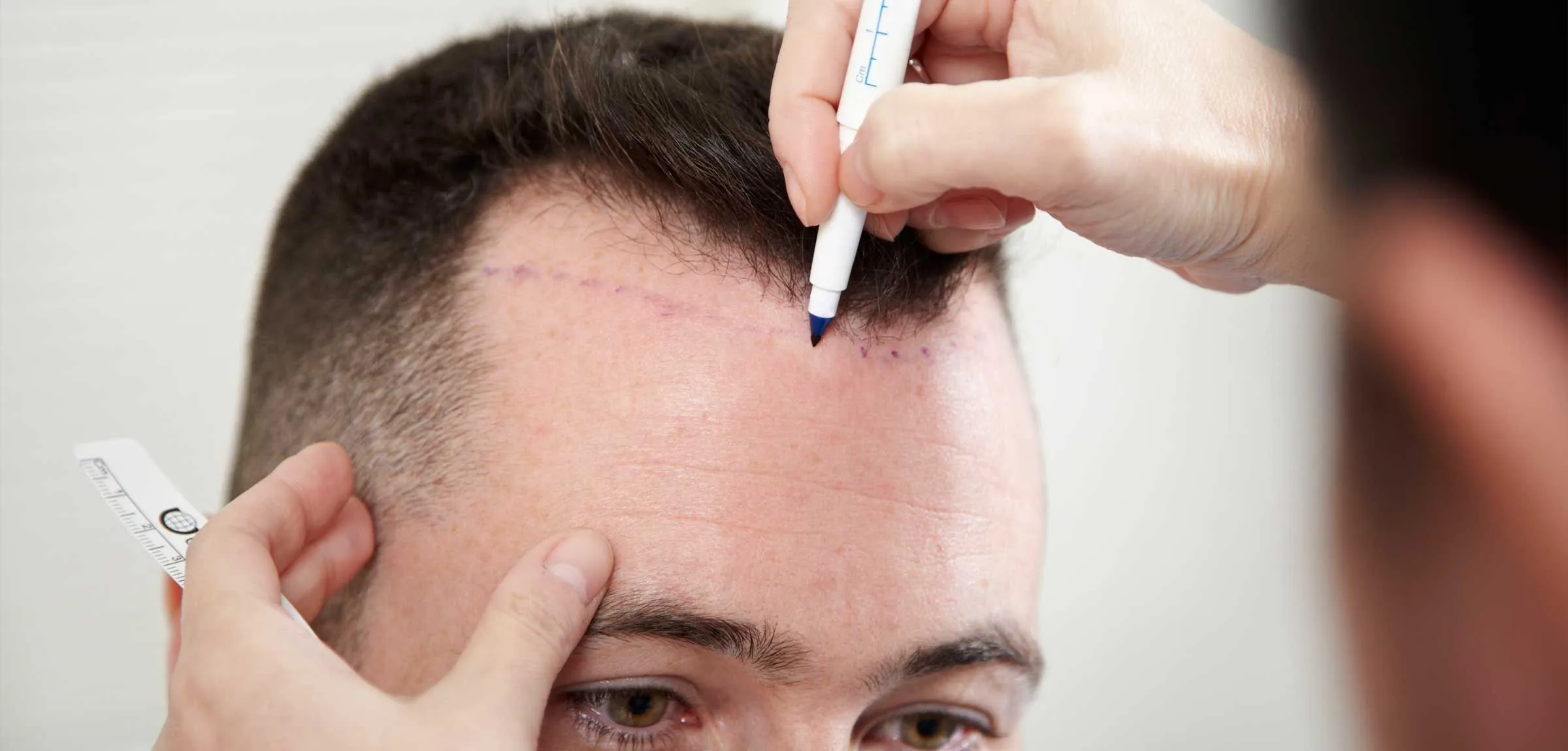 Hair Transplant UK – Advanced FUE &amp; FUT Hair Restoration Solutions